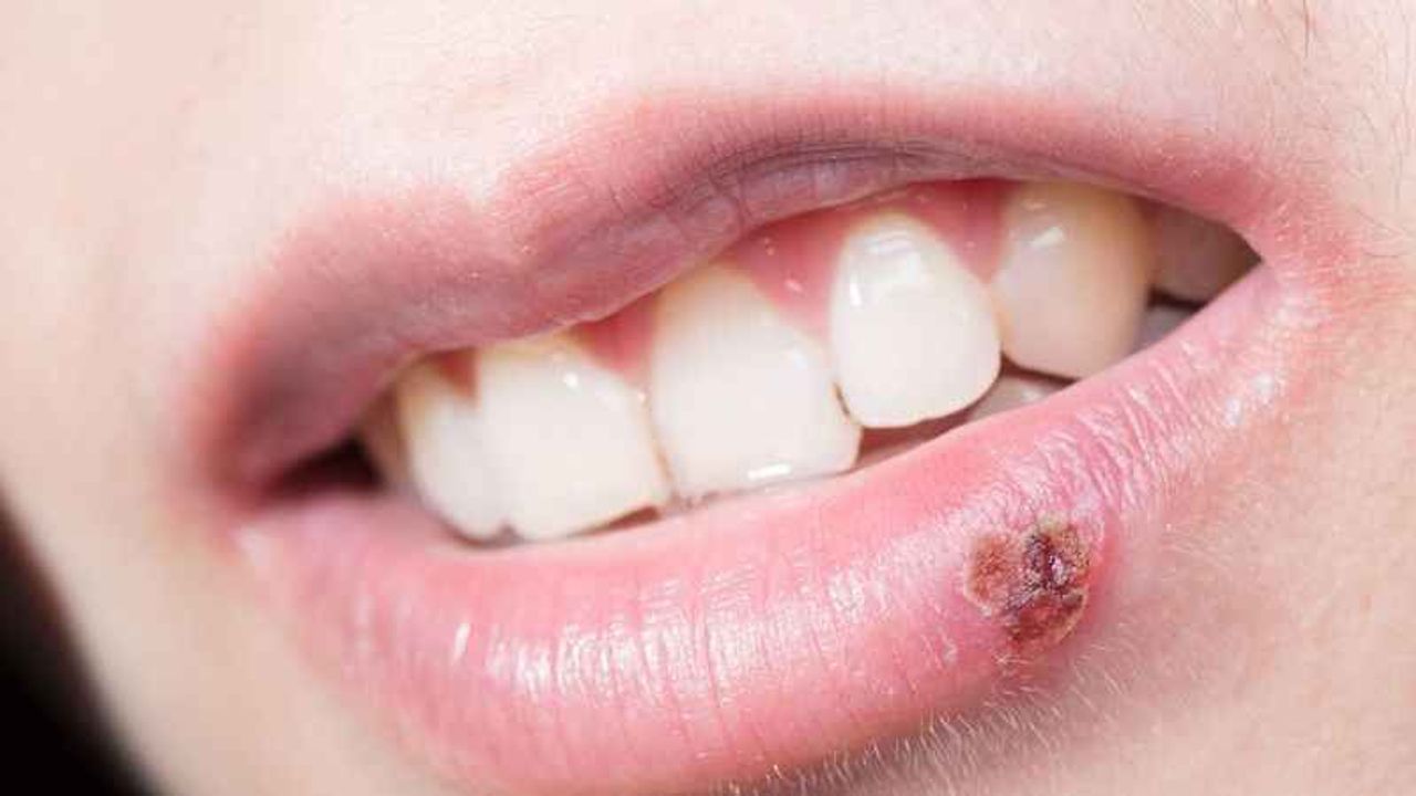 Uçuk Nedir? Uçuk Neden Çıkar?