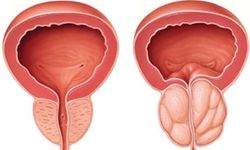 Benign Prostat Hiperplazisi Nedir