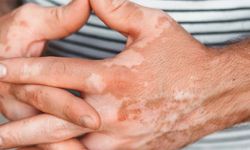 Vitiligo Olmayan Beyaz Lekeler Nedir