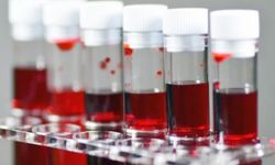 Kalp Krizi Riskinde Kan Grubu Faktörü: Araştırmalar Hangi Grubu İşaret Ediyor?