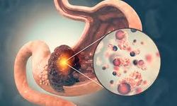 Antibiyotik Hatası Kolon Kanserine Zemin Hazırlıyor! Uzmandan Uyarı: “Bağırsaklar 6 Ay Boyunca Hasarı Onaramıyor”