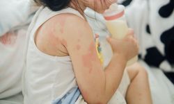 Bebeklerde ve Çocuklarda Alerji Hakkında Yanlış Bilinenler