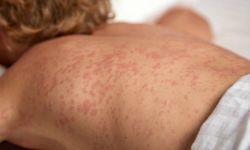 Kızamık Alarmı: Türkiye ve Dünyada Vaka Sayıları Hızla Yükseliyor