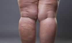 Sessizce İlerliyor, Hayatı Kısıtlıyor: Lipödem Tedavi Edilmezse Yürümek Bile Zorlaşıyor