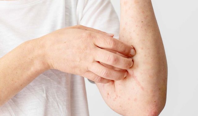 Dermatologlar Uyardı: Stres Zona Hastalığını Tetikliyor!