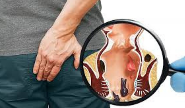 Yozgatlılar Dikkat! Basur Belirtilerini Sakın Hafife Almayın