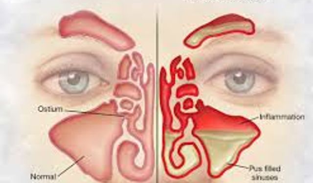 Yozgat'ta Soğuk Hava Sinüziti Tetikliyor: İşte Alınacak Önlemler