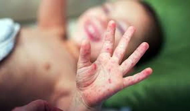 Yozgat’ta Çocuklarda El Ayak Ağız Hastalığına Karşı Uyarı