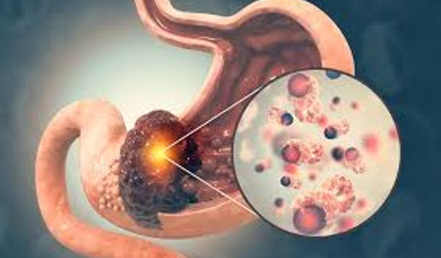 Yozgat’ta Mide Kanseri Hakkında Bilinmesi Gerekenler