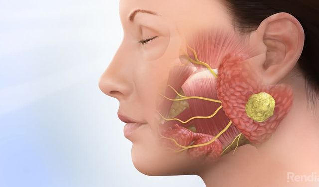 Yozgat’ta Tükürük Bezi Kanseri ile İlgili Merak Edilen Sorular