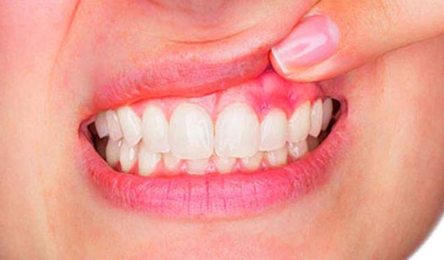 Apseye Dikkat: Belirtileri ve Riskleri Nelerdir?