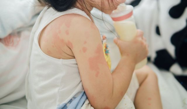 Bebeklerde ve Çocuklarda Alerji Hakkında Yanlış Bilinenler