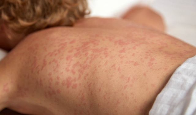 Kızamık Alarmı: Türkiye ve Dünyada Vaka Sayıları Hızla Yükseliyor