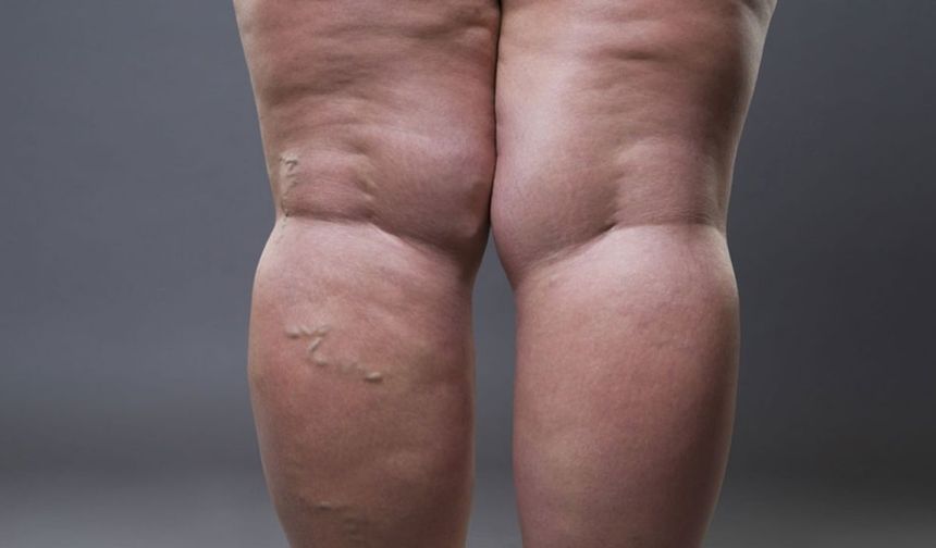 Sessizce İlerliyor, Hayatı Kısıtlıyor: Lipödem Tedavi Edilmezse Yürümek Bile Zorlaşıyor