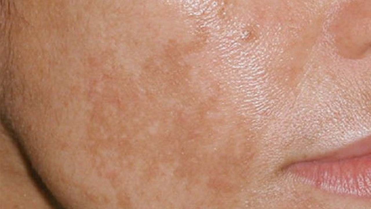 Vitiligo (1)