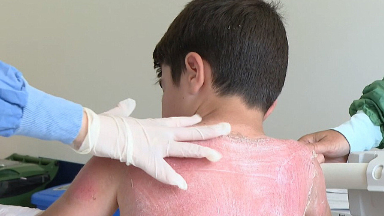 Güneşte 4 Saat Kalan 7 Yaşındaki Çocuk İkinci Derece Yanıkla Hastanelik Oldu