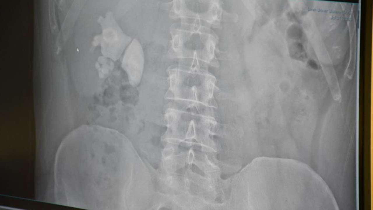 Şehir Hastanesi Böbrek Taşı (3)