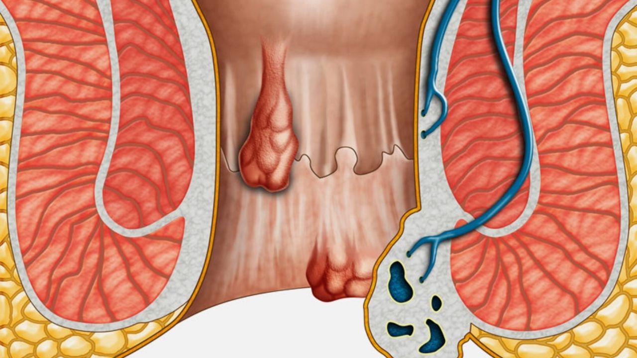 Basur Belirtilerini Sakın Hafife Almayın-1