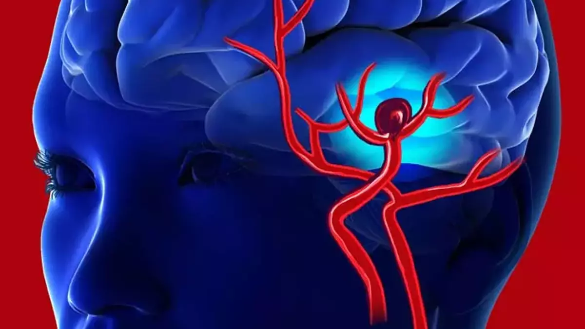 Beyne Pıhtı Atması Hayati Risk Taşıyor