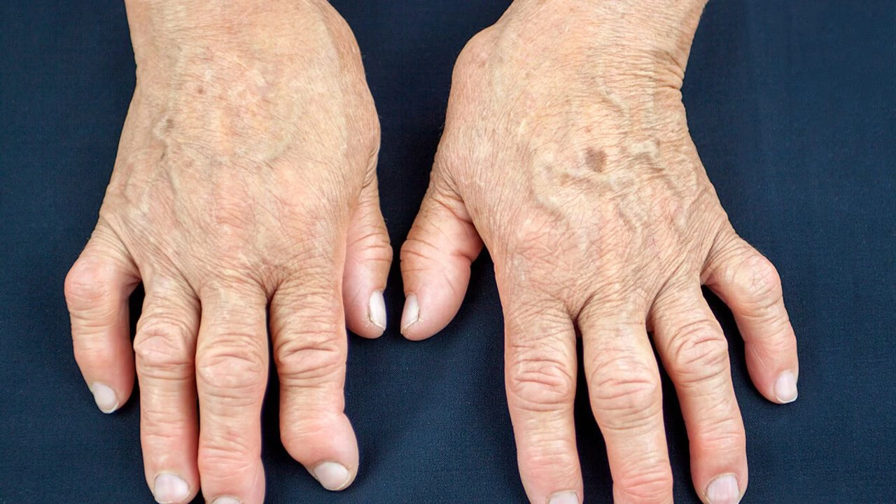 Romatoid Artrit Alarmı-1