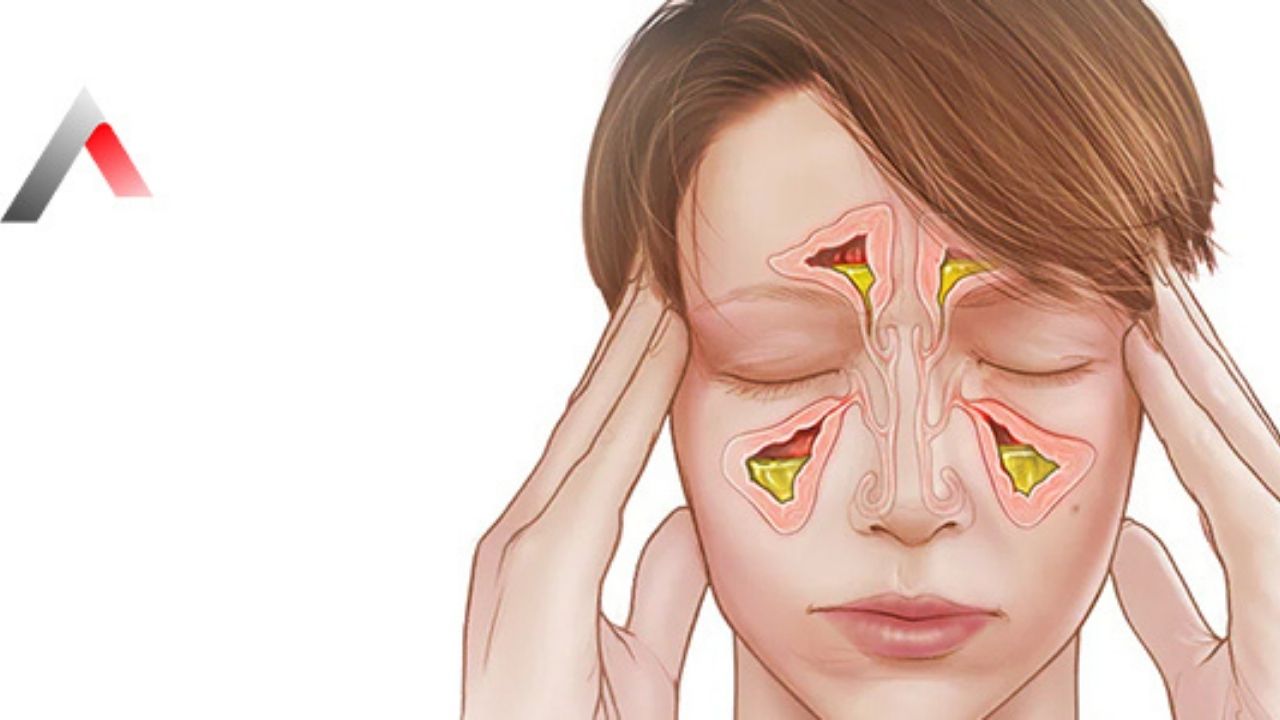 Sinüzit Nedir, Neden Olur-1