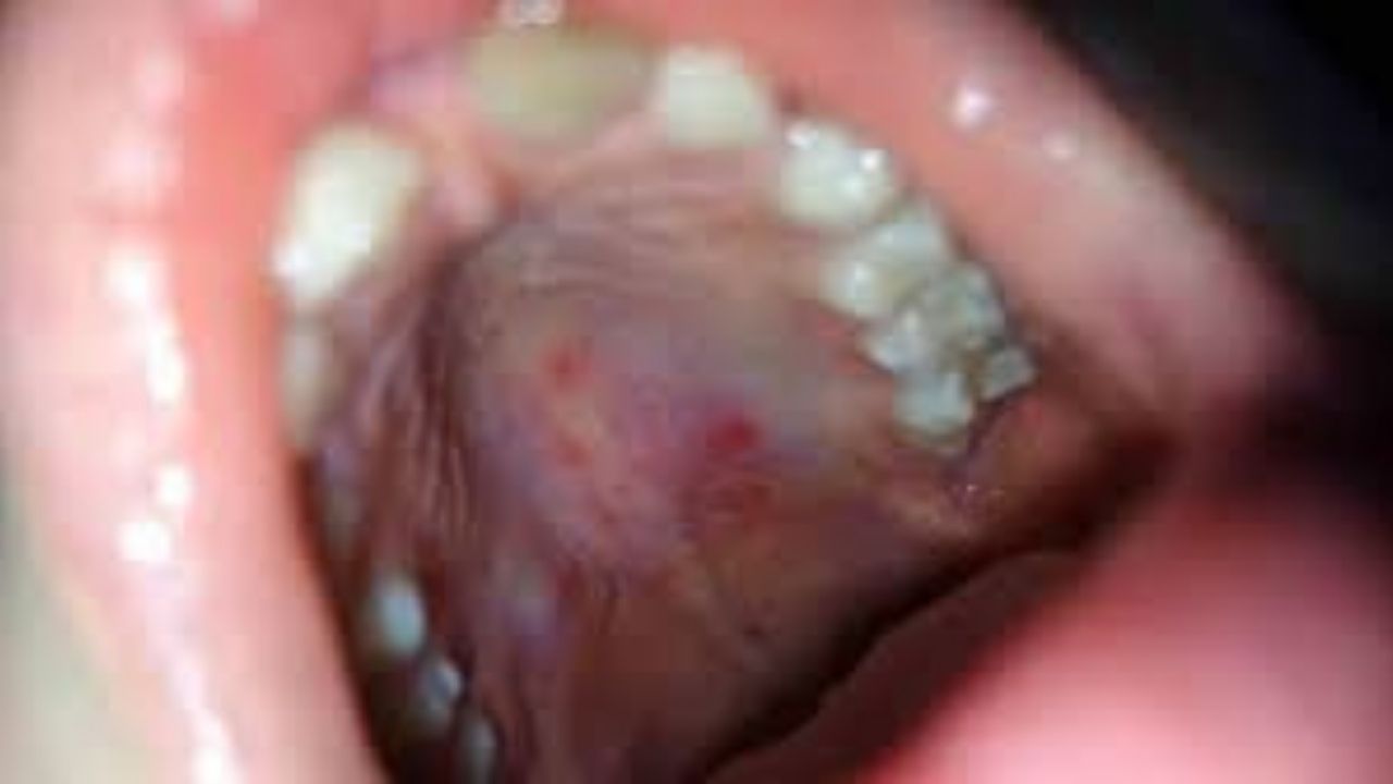 Yozgat’ta Çocuklarda El Ayak Ağız Hastalığına Karşı Uyarı-2