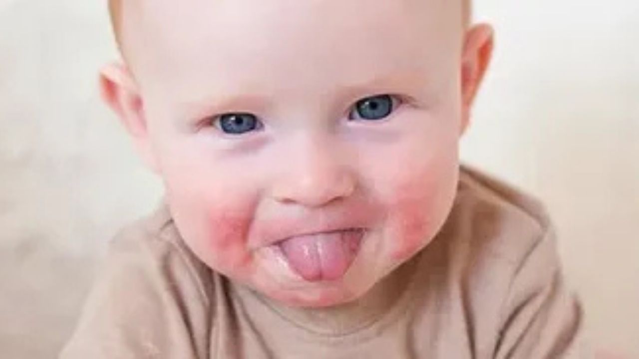 Bebeklerde Ve Çocuklarda Alerji Hakkında Yanlış Bilinenler (2)