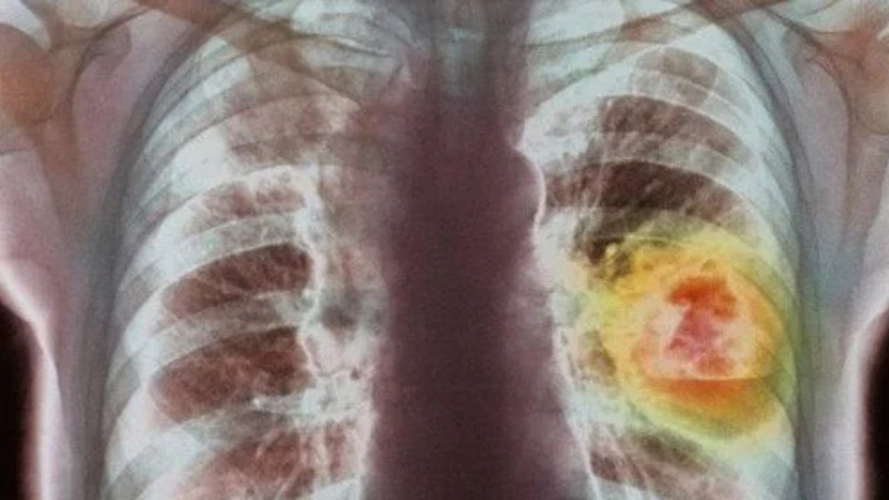 Yeni Nesil Kanser Tedavisi Uygulanıyor-1