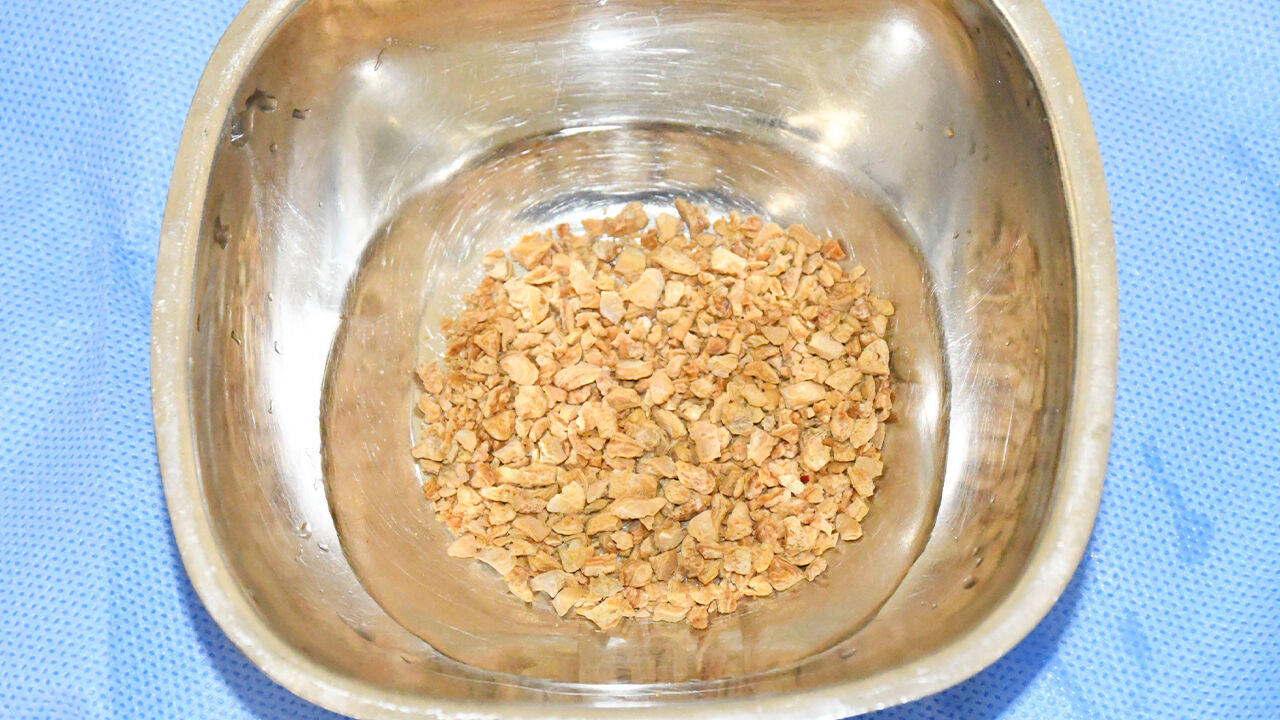 Taş Cerrahisinde Milimetrik Devrim (4)